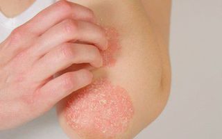 Image for Healing touch: how massage therapy can soothe eczema symptoms