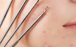 Image for Everything You Need to Know About Acne