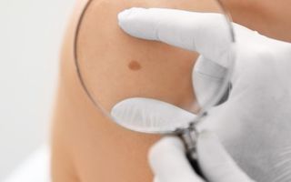 Image for Natural ways to support melanoma treatment safely