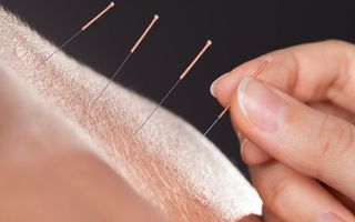 Image for Dry needling vs acupuncture: what