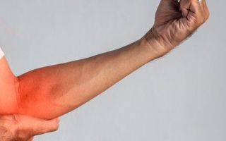 Image for 8 proven natural remedies for tennis elbow pain relief
