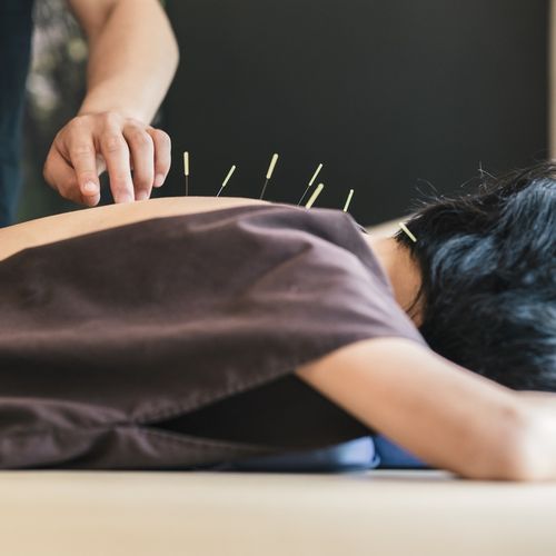 Acupuncture for Osteoporosis | Acupuncturists Treating Osteoporosis in ...