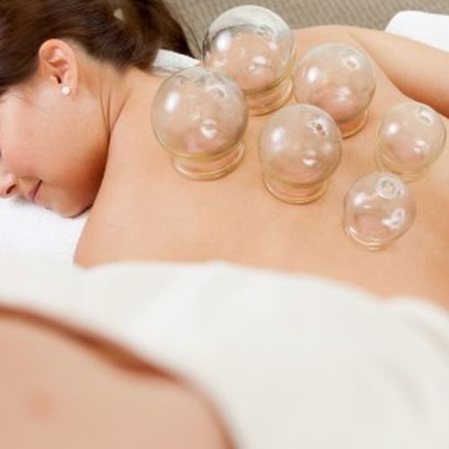 Cupping for Boxing Day Shopping Fatigue Relief | NaturalTherapyPages.com.au