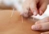 Jacaranda Therapies - Acupuncture