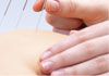 Perth Acupuncture and Pain Clinic - Acupuncture