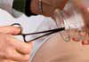 Fusion Body Therapy - Cupping