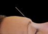 China Dragon Medical - Acupuncture