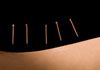 Pins 'N' Potions - Acupuncture
