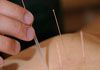 Bing's Natural Health - Acupuncture