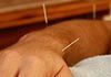 Brunswick Traditional Chinese Medical Centre - Acupuncture & Cupping