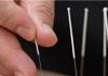 Wise Acupuncture - Acupuncture & TCM Treatments