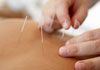 Rochedale Chiropractic - Dry Needling or Western Acupuncture