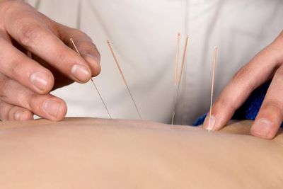 Acupuncture Service